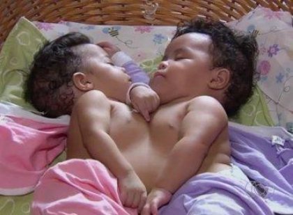 Gêmeas siamesas baianas estão em estado grave após cirurgia de separação em Goiás